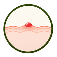Cherry Angiomas