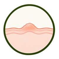 Common Warts