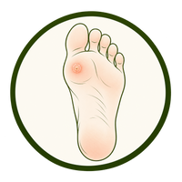 Plantar Warts