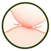 Friction & Skin Folds