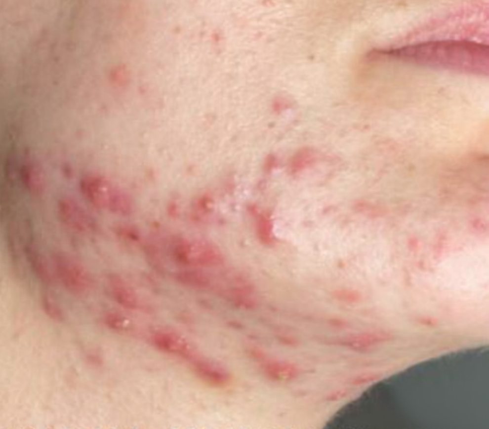 Before treatment