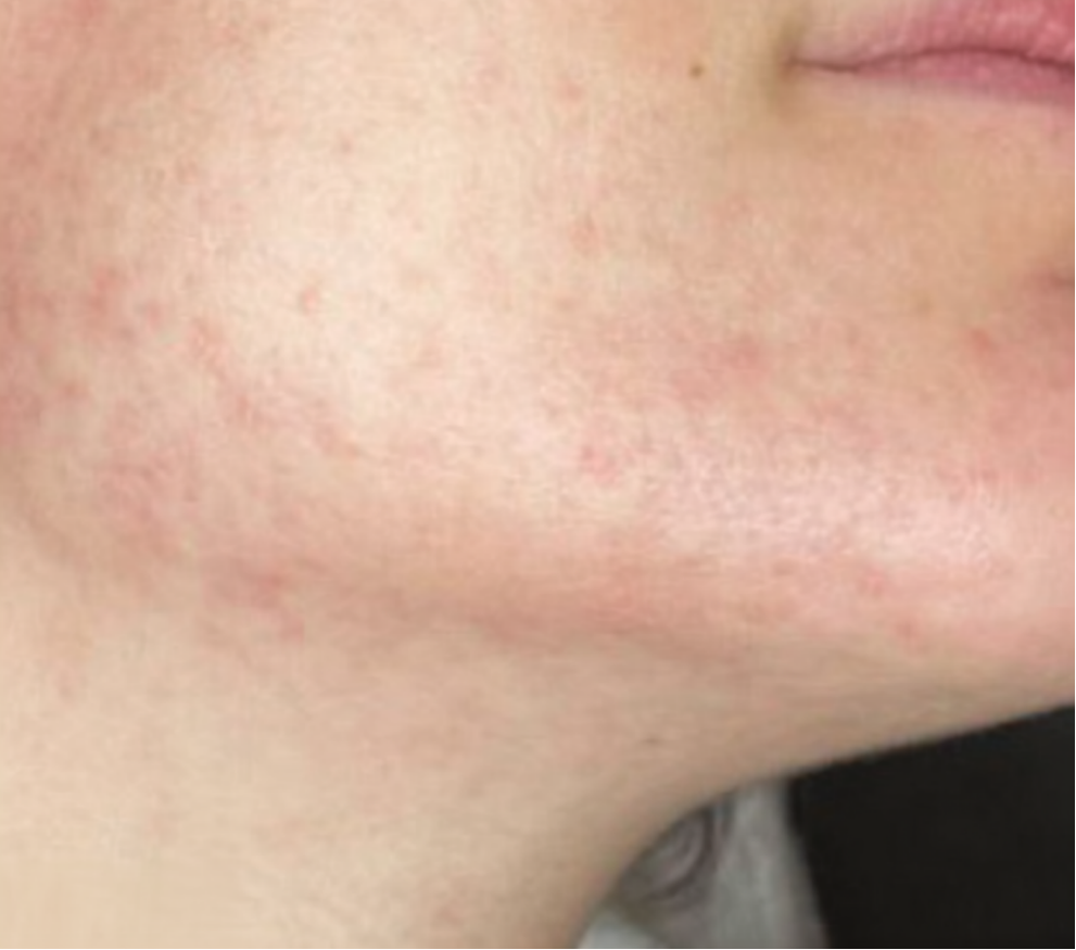 After treatment