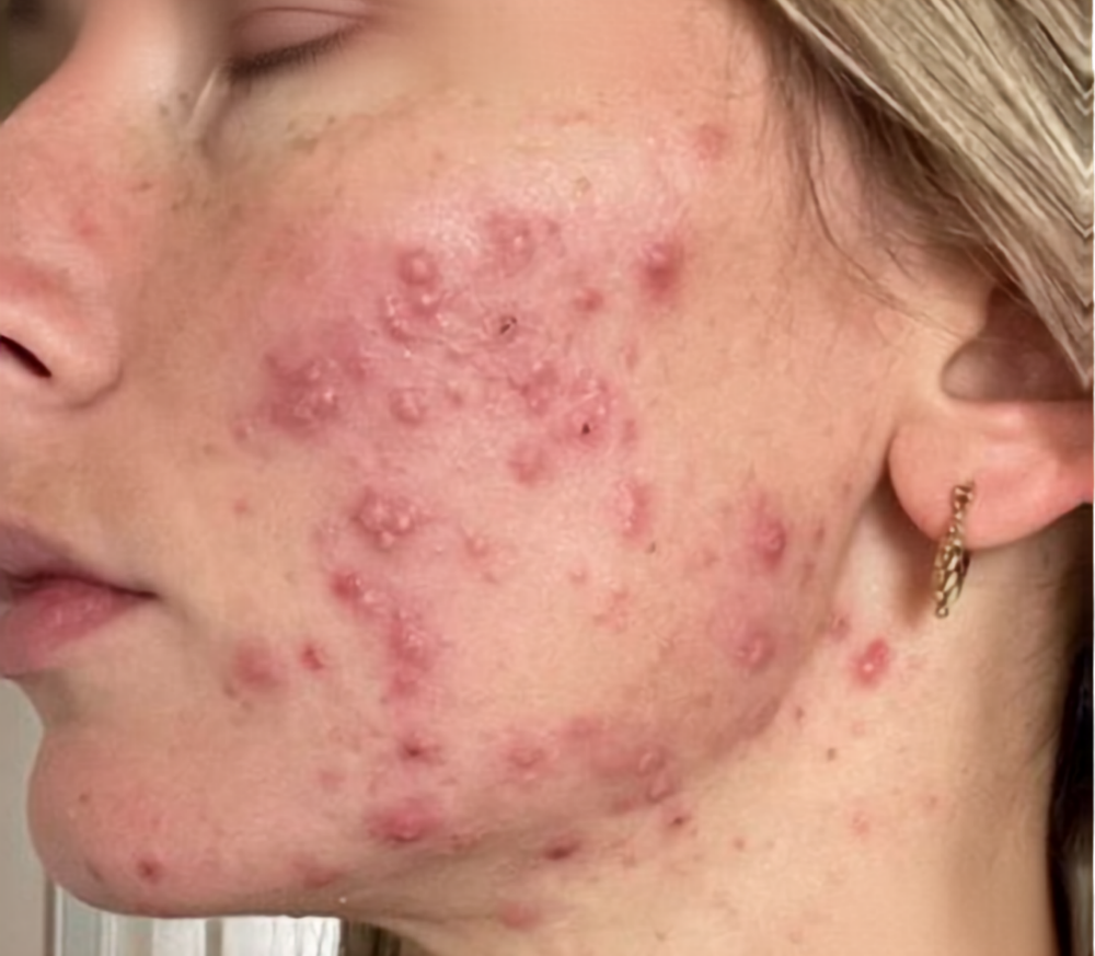 Before treatment