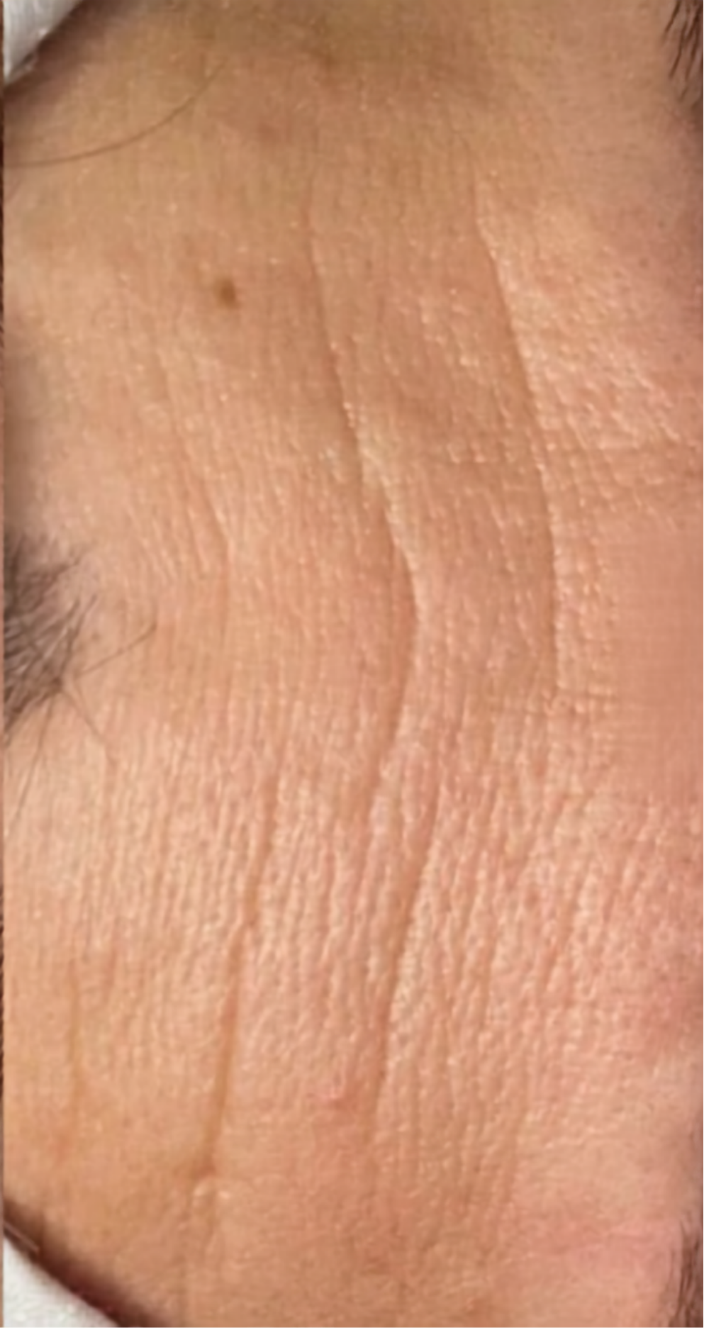 Before treatment