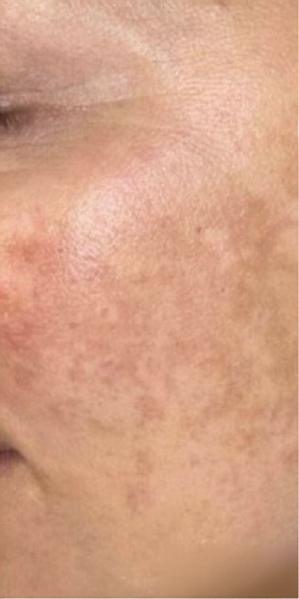 Before treatment