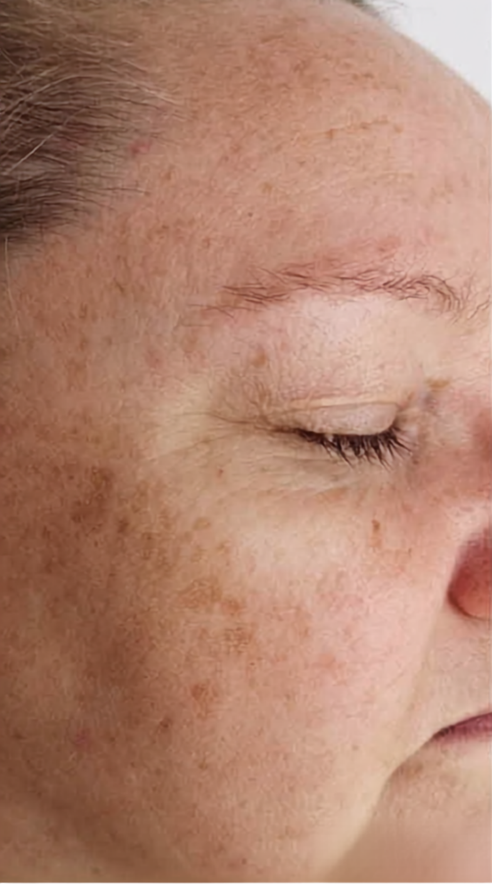 Before treatment