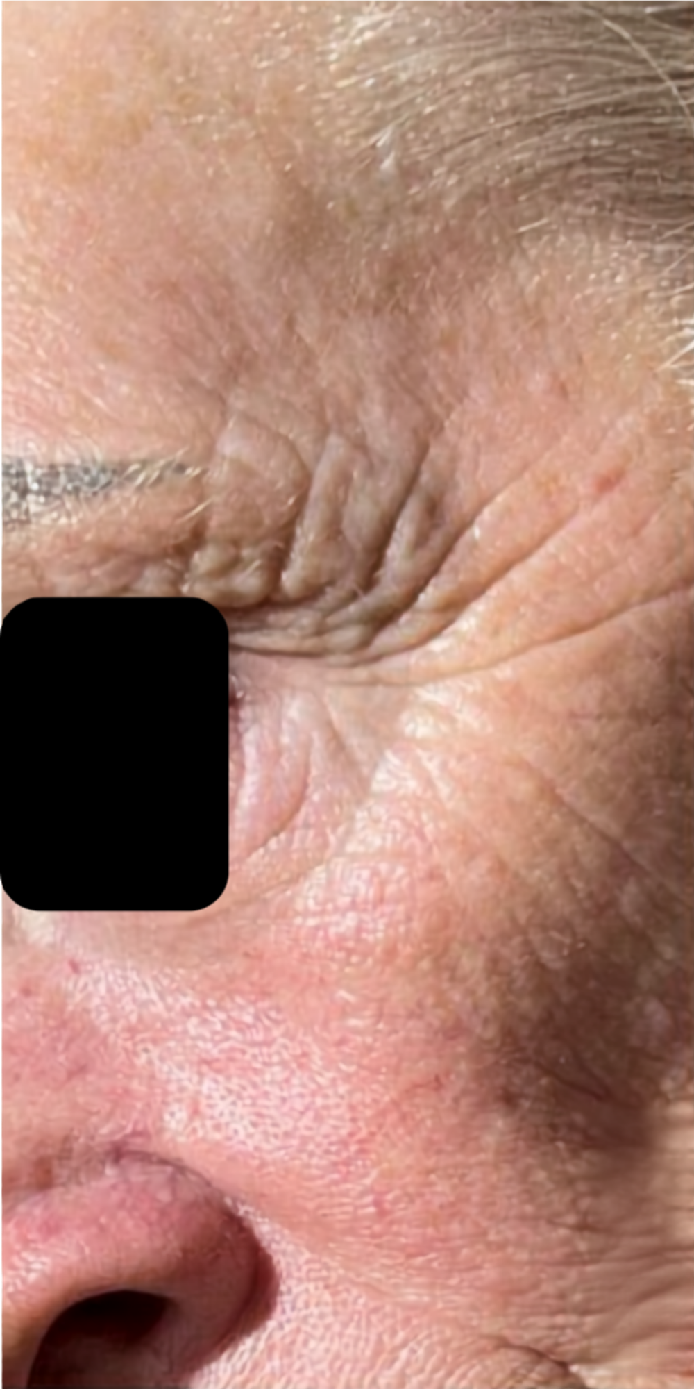Before treatment