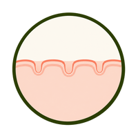 Enlarged Pores