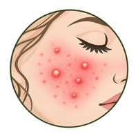 Papules & Pustules