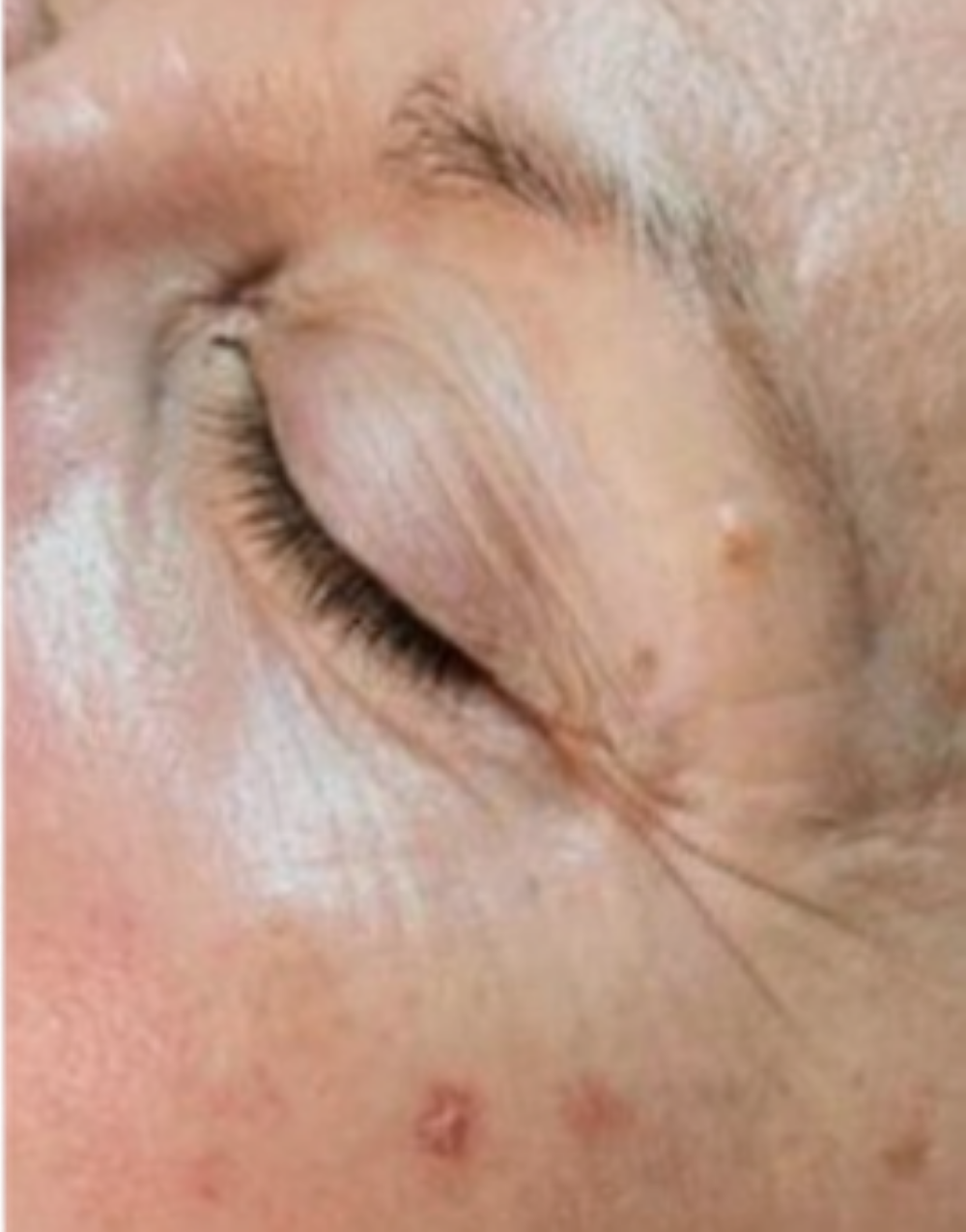 After treatment