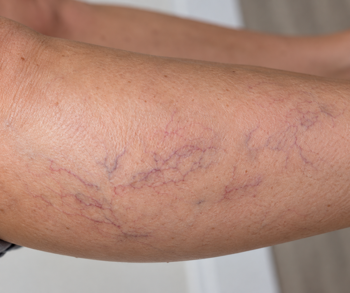 Close-up of a human leg showing visible spider veins and skin texture for treatment with Aerolase Neo Elite Laser