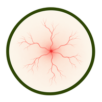 Spider Angiomas