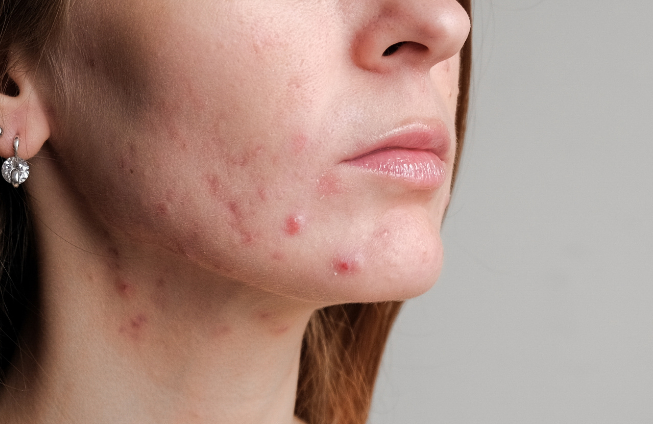 Woman with active acne and breakouts on the cheeks and jawline