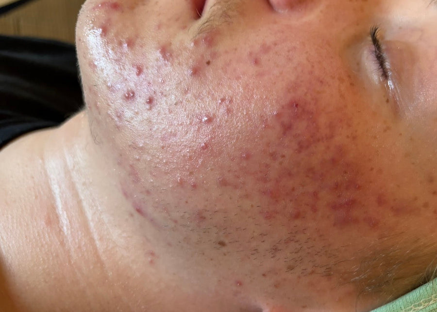 Acne & Acne Scarring