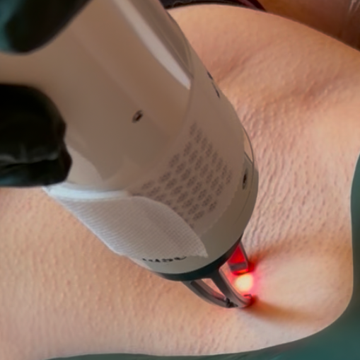 Laser Hair Removal