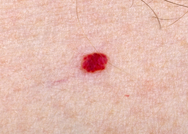 Close-up of a cherry angioma, a small red vascular skin lesion.