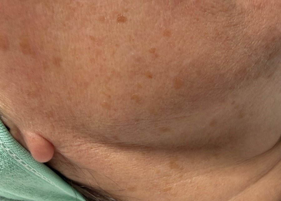 Pigmentation & Melasma