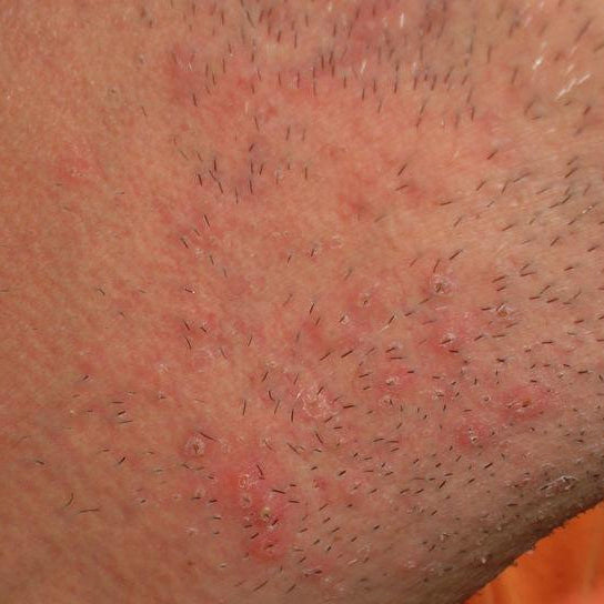 Ingrown Hairs & PFB