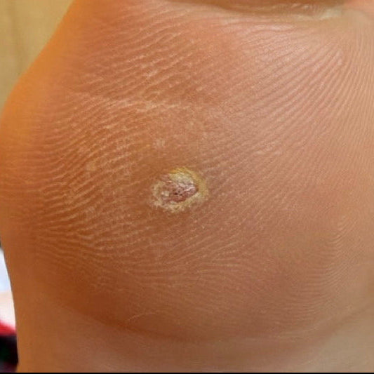 Plantar wart on the foot before Aerolase laser treatment at Woodland Skin Renewal in North Pickering, Ontario.