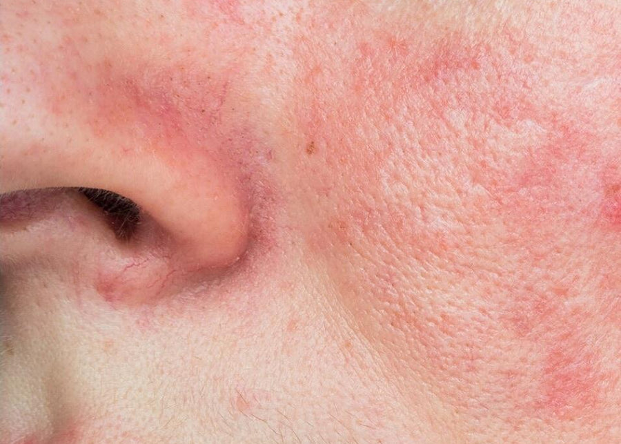 Redness & Rosacea