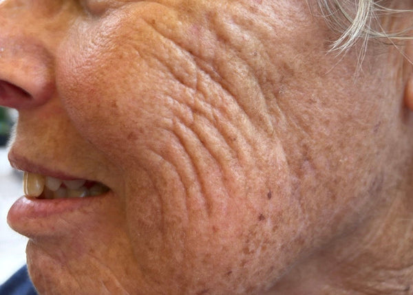 Mature skin with fine lines and sun damage before Aerolase skin rejuvenation treatment in North Pickering, Ontario.