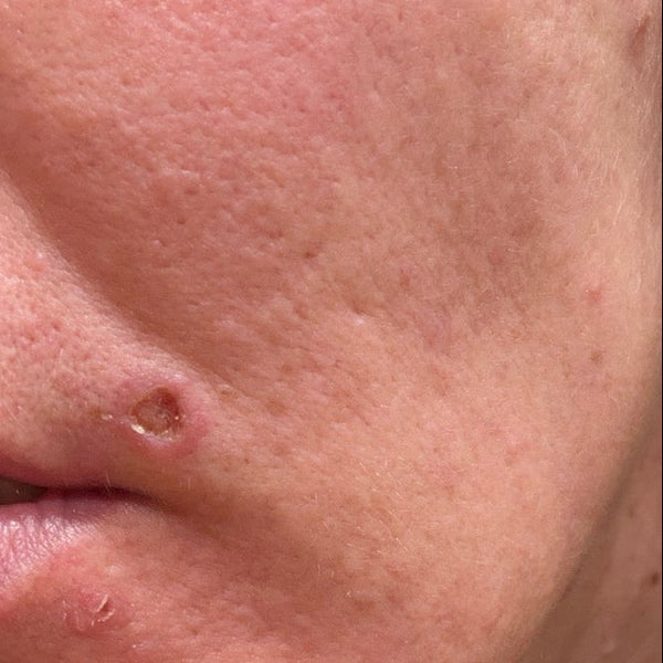 Uneven skin texture and facial scarring treated with Aerolase Neo Elite at Woodland Skin Renewal in Pickering.